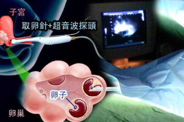 南京代孕网的代孕流程